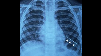 Delhi doctors use magnet to remove needle from boy’s lung