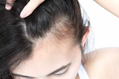 ​How to stop thinning of hair