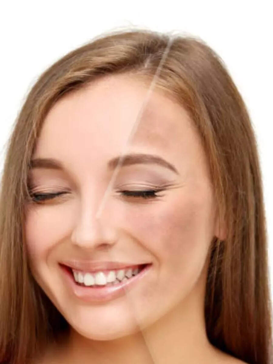 9 Home Remedies To Lighten Hyperpigmentation Times Now