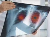 Environmental factors and lung cancer risk Environmental factors and lung cancer risk