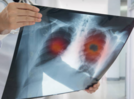 Environmental factors and lung cancer risk: What you need to know