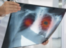 Environmental factors and lung cancer risk