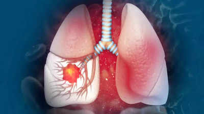 Advancements in lung cancer treatment: Targeted therapies and immunotherapy
