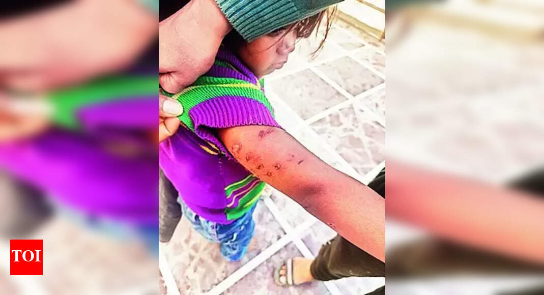 Minor Injured In Stray Dogs’ Attack | Ludhiana News - Times of India