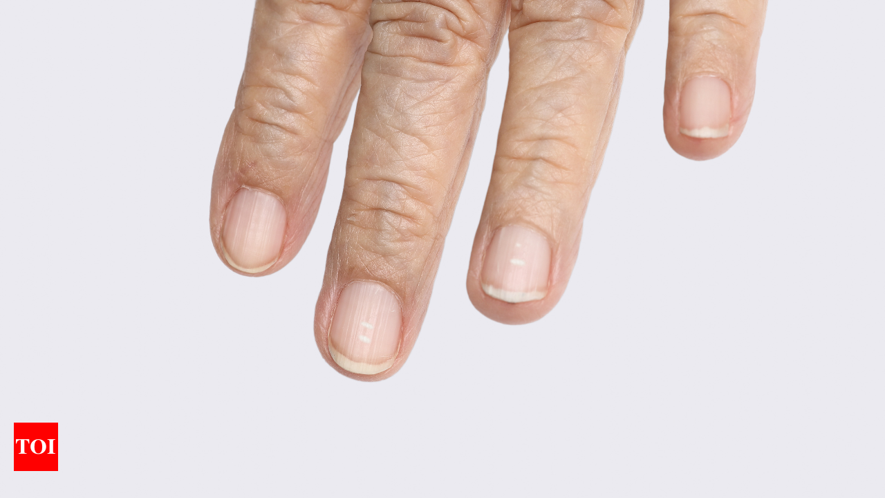 Closeup of the fingers of a patient with Psoriatic onychodystrophy or  psoriatic nails disease Stock Photo | Adobe Stock