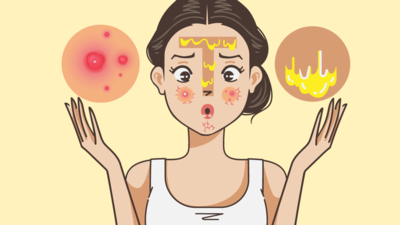 Face map of acne: What pimples on various parts of your face mean