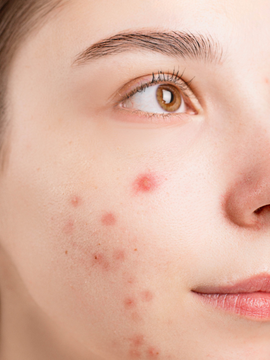 Ayurvedic Remedies For Acne Times Now