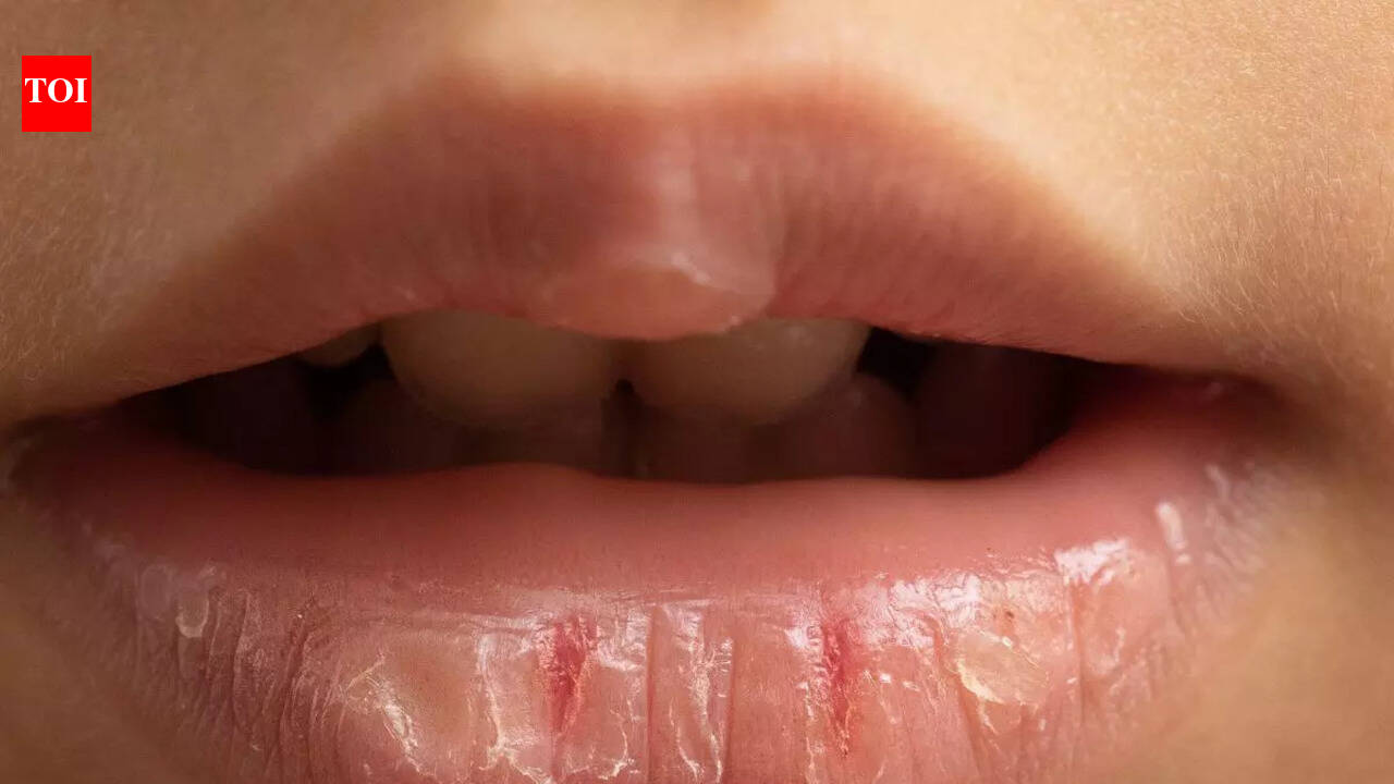 Common foods that can prevent and heal chapped lips