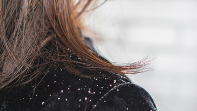 5 Simple But Effective Ways To Get Rid of Winter Dandruff