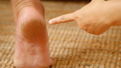 Get rid of hot sale cracked heels at home