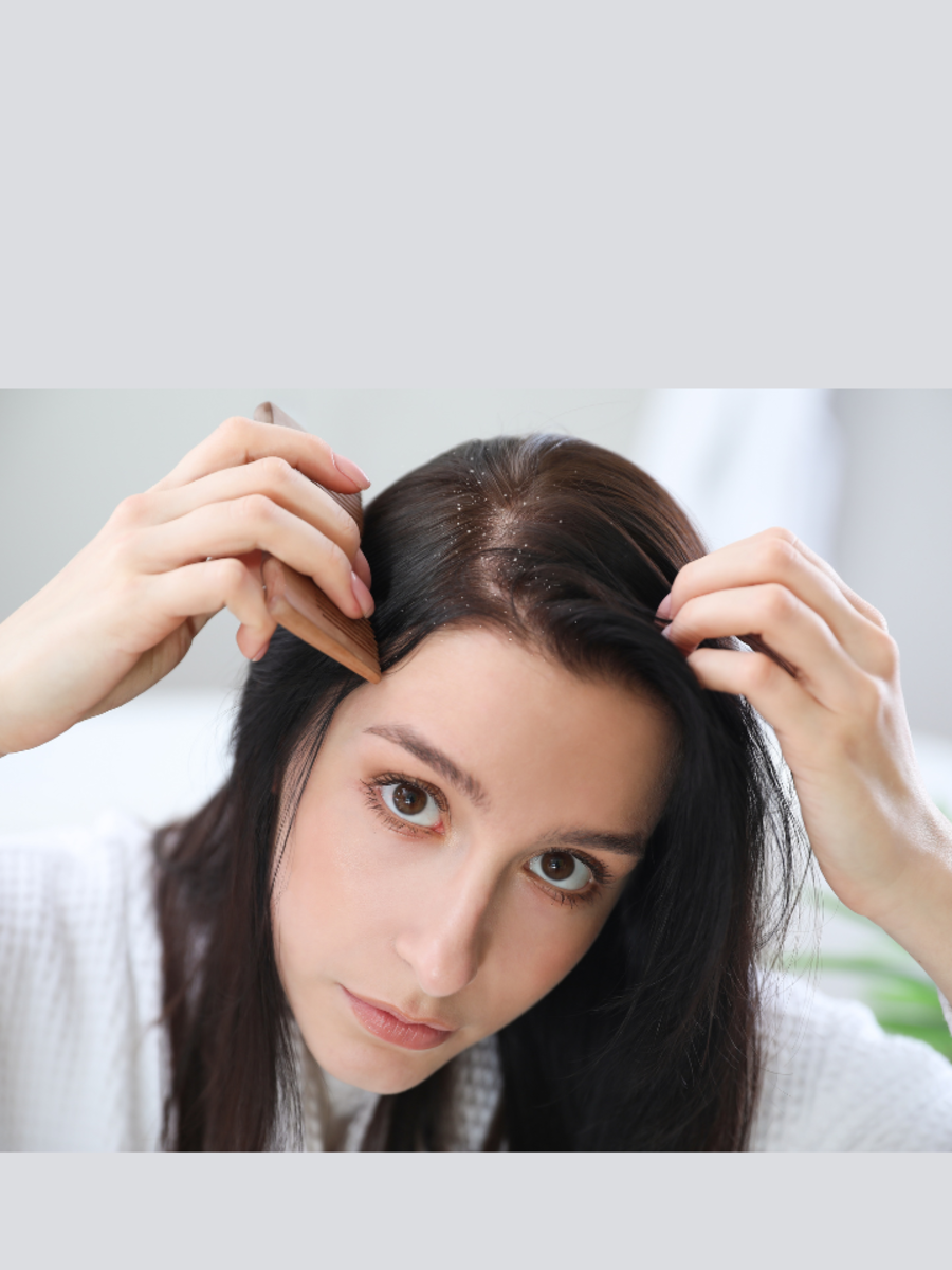 Ayurvedic Remedies To Cure Dandruff | Times Now