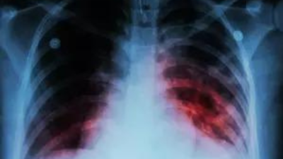Novel approach identifies people at risk of developing TB: Lancet study