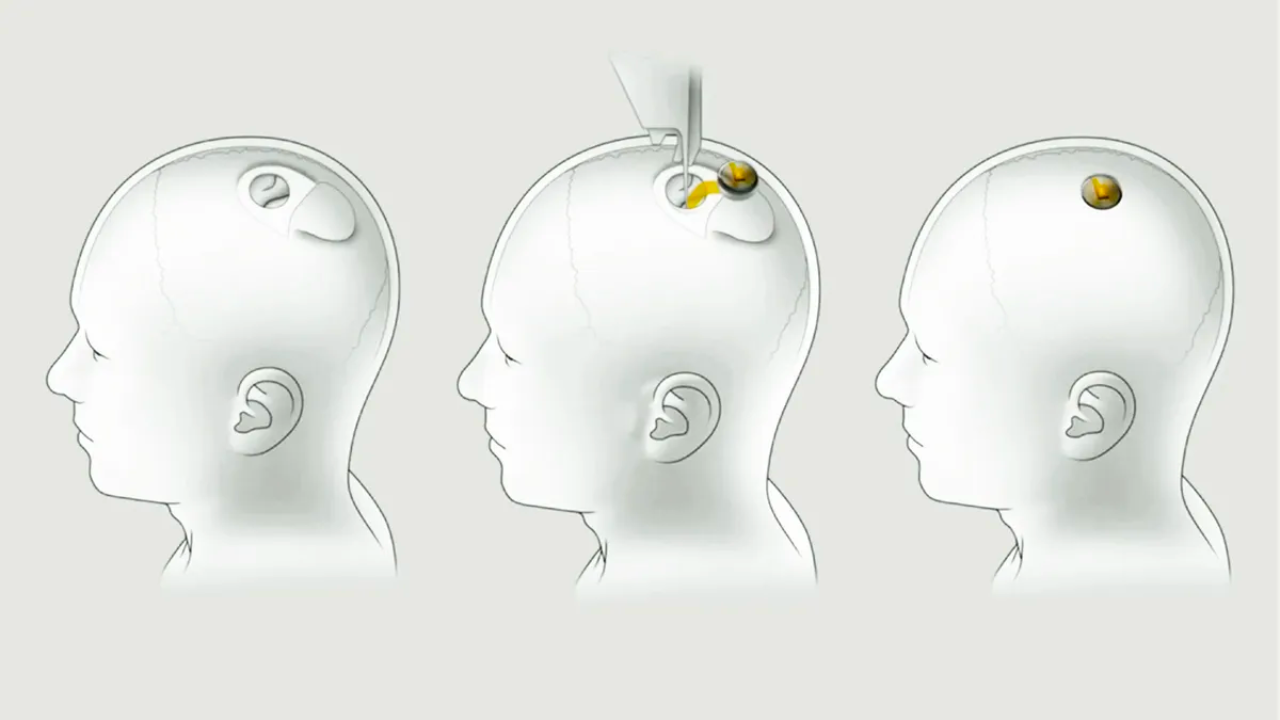 Elon Musk’ın Neuralink ‘i Beyin Çipi Yerleştirilen Hastanın Satranç Oynadığı Bir Canlı Yayın Paylaştı