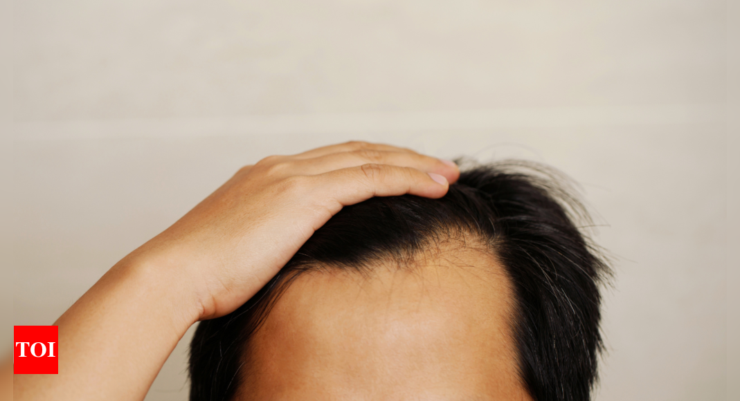 Hair Fall Causes: 5 causes of baldness in men and how to treat it |