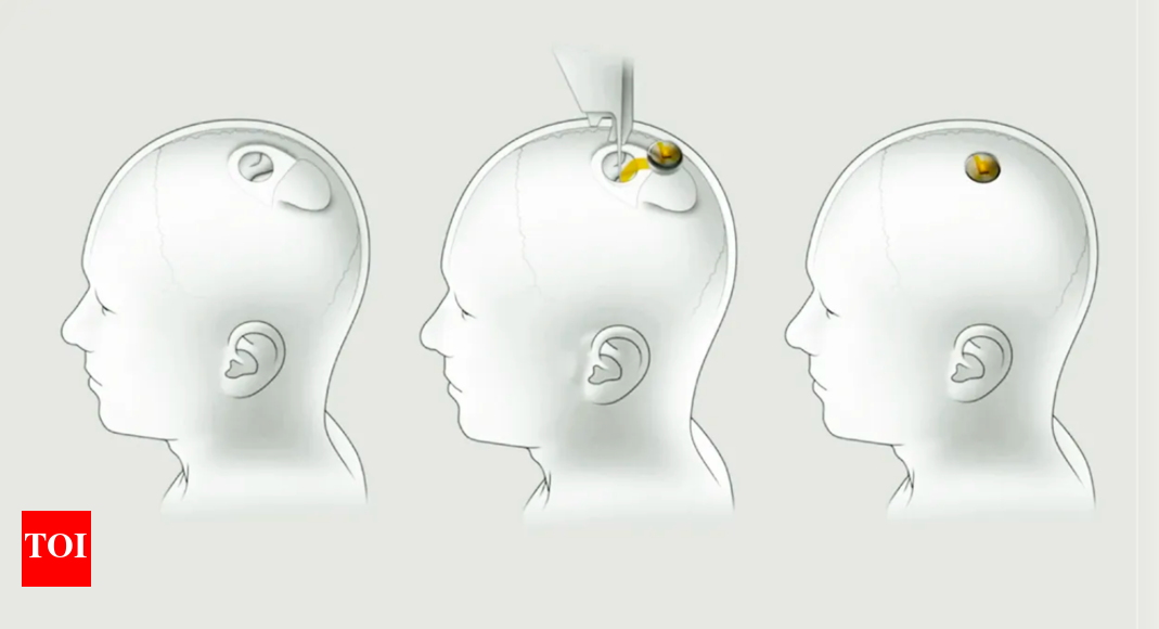 Elon Musk Gives Update on First Patient with Neuralink Brain Chip ...