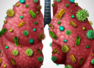 Increasing Pneumonia Risk: Protect your lungs with these simple tips