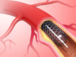 Explained: Coronary Angioplasty with Stenting to fix clogged arteries