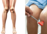 Knock knees: Can it be treated and how to recognise signs