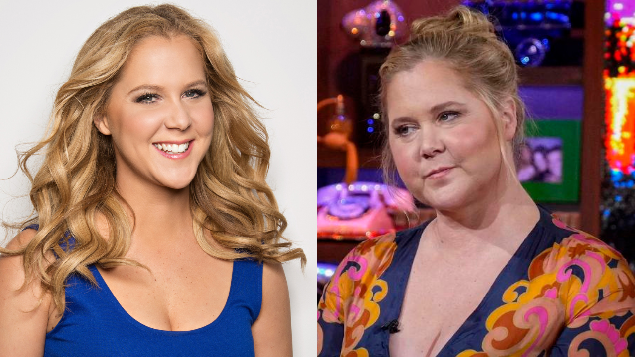 Amy Schumer Says She Has Cushing's Syndrome, a Hormonal Disorder - The New  York Times