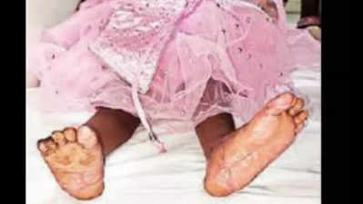 Three-year-old girl’s legs reattached