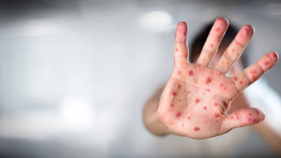 Over 6,000 chickenpox cases, nine deaths in Kerala: Symptoms and prevention tips