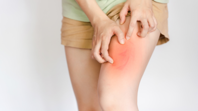 Skin chafing on thighs? Things to prevent and heal this painful