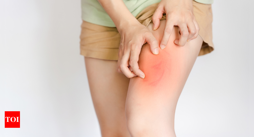 Skin chafing on thighs? Things to prevent and heal this painful condition -  Times of India