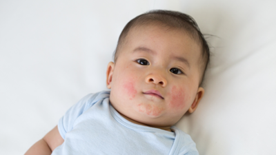 Eczema: Tips to prevent this skin problem in children