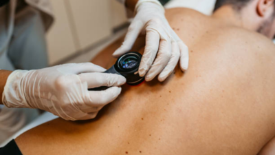 Melanoma: All about the risks, symptoms, and common myths