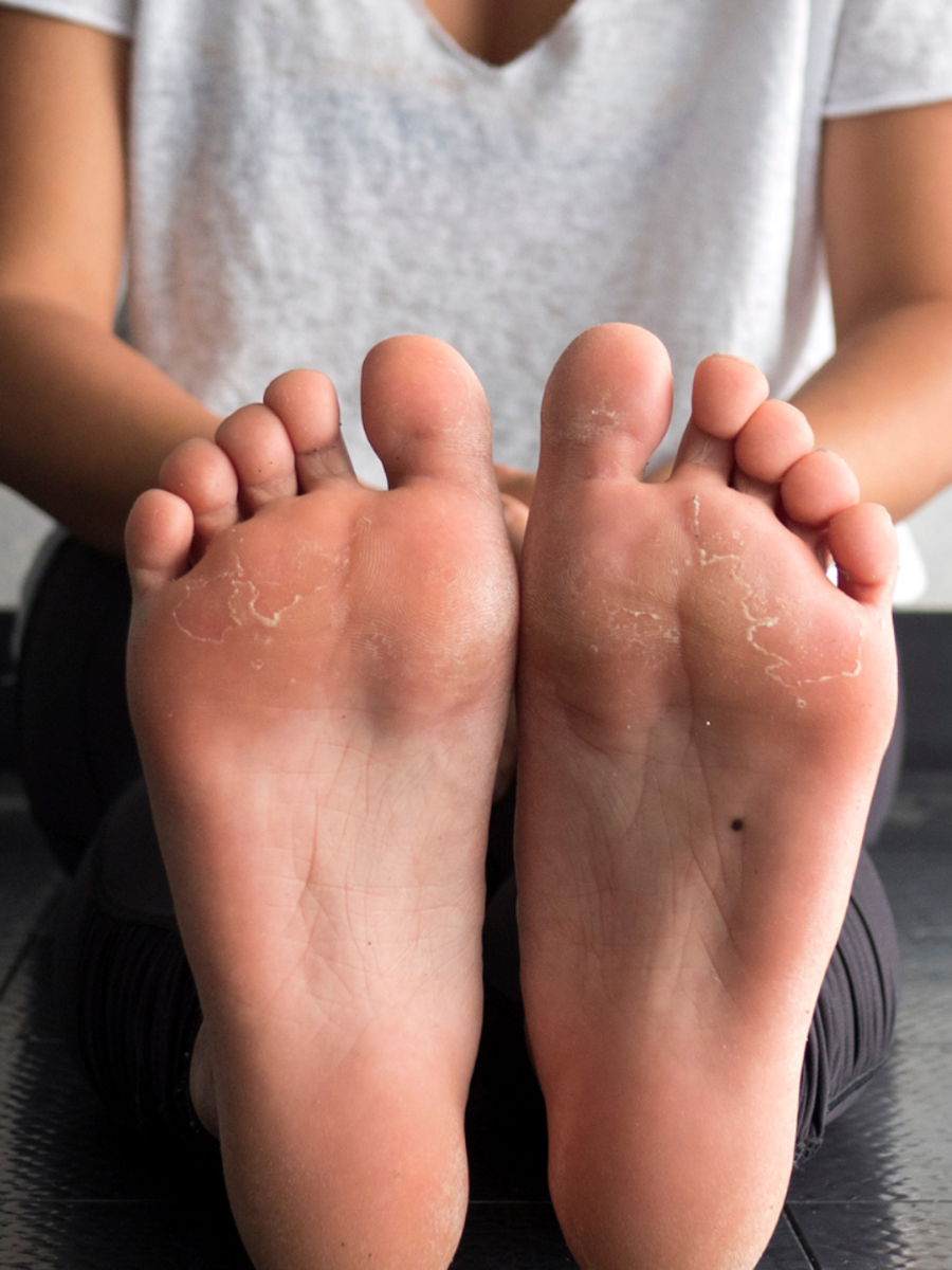 ​10 warning signs of high cholesterol you shouldn't ignore - Vimarsana News