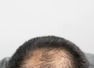 Explained: How to undergo a hair transplant