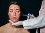 All about Vampire Facial, beauty treatment that left 3 women infected with HIV