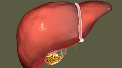 Gallbladder Stones 101: A comprehensive guide to cholelithiasis