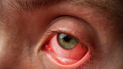 Conjunctivitis in the summer: Causes, symptoms, and treatment