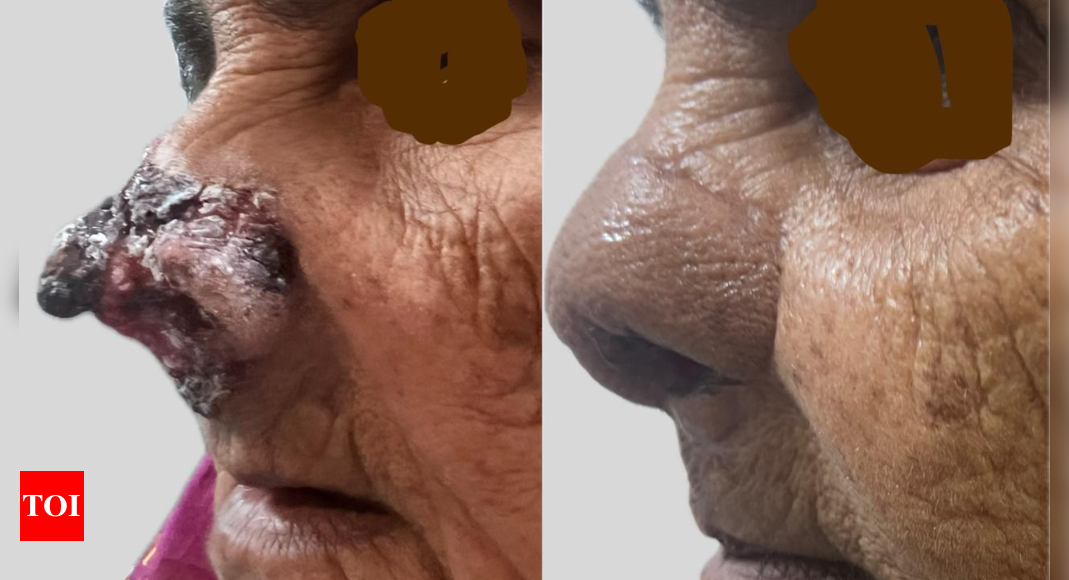 Rare nose reconstruction surgery was performed on 75-year old woman in Guntur