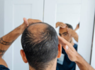 Is platelet-rich plasma treatment the ultimate solution for hair loss?