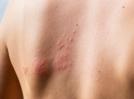 Early symptoms of shingles that you must not ignore