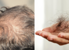 5 serious causes that may be causing hair fall