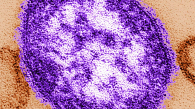 Ontario reports first death from measles in over a decade