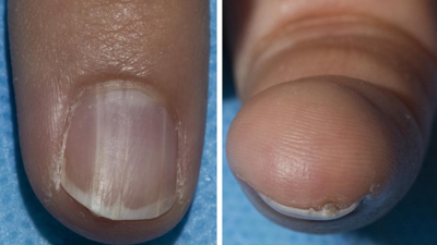 Can your nails reveal hidden cancer risks?