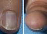 Can your nails reveal hidden cancer risks?
