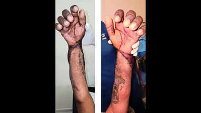 Two get hand transplants in city