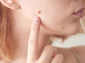 Do THESE moles indicate love marriage for women?