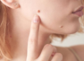 Do THESE moles indicate love marriage for women?