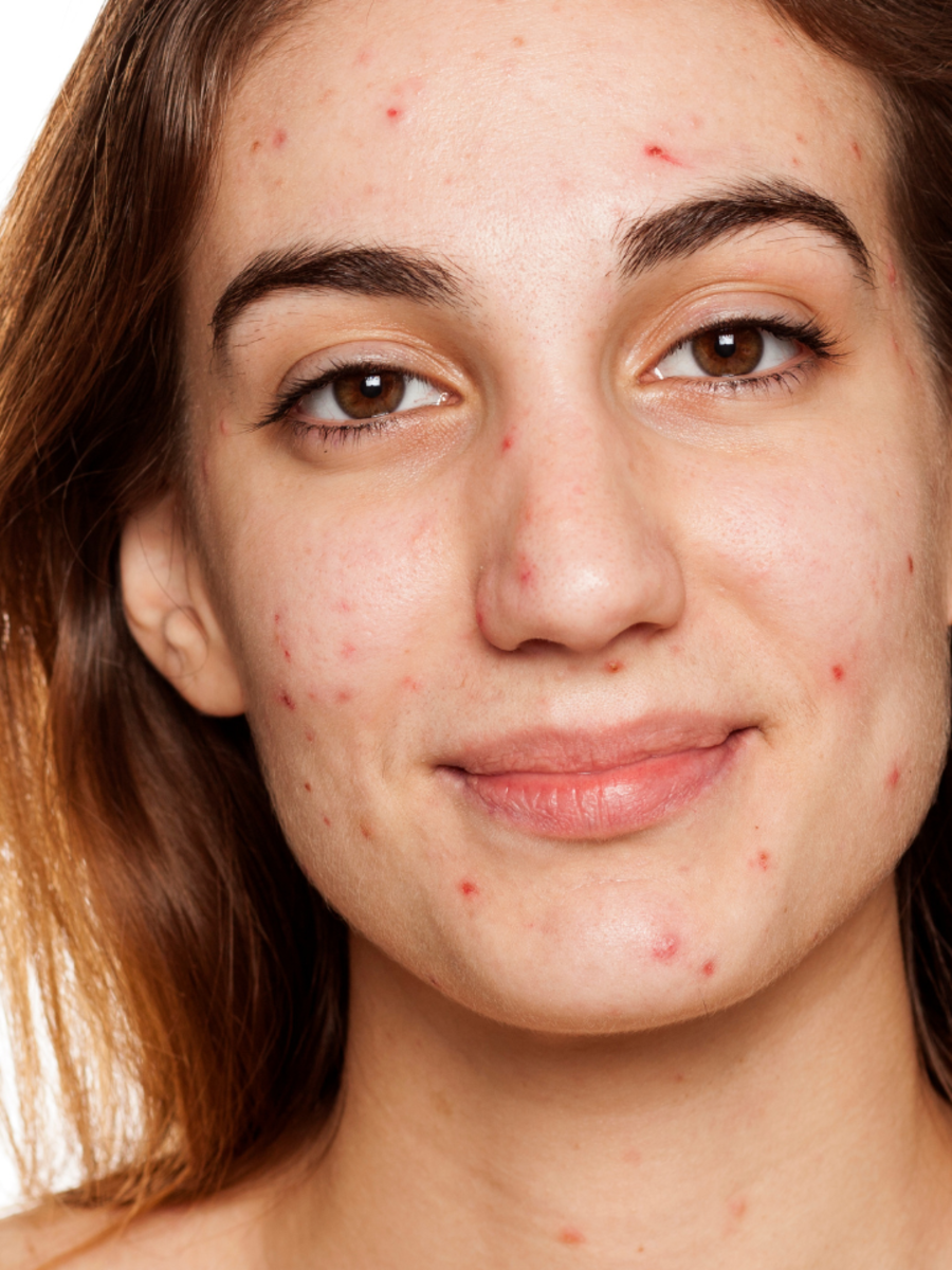 Signs you've hormonal acne and tips to heal it | Times of India