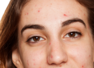 Signs you've hormonal acne and tips to heal it