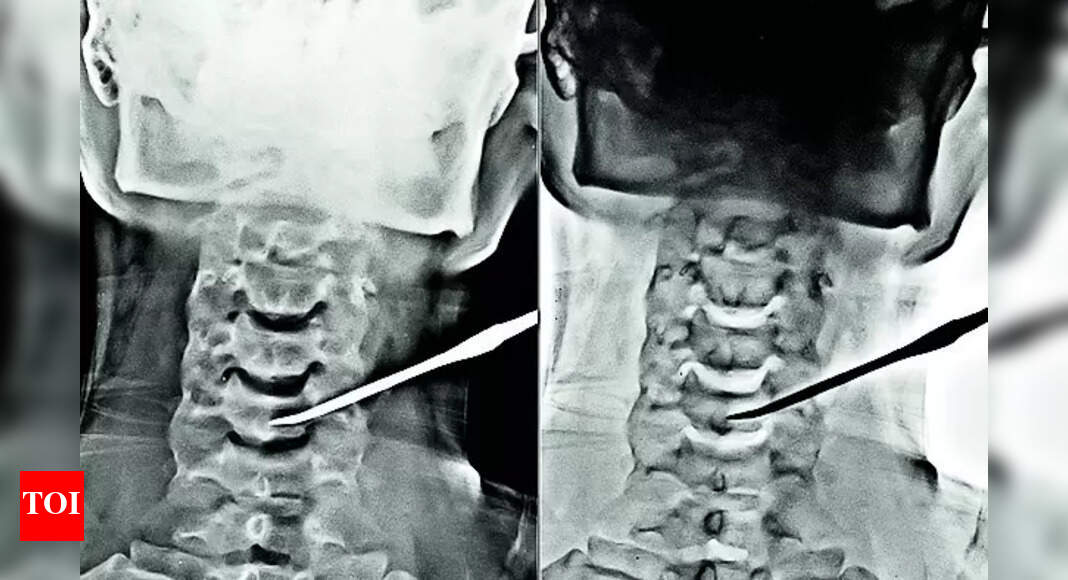 Arrowhead: MP man with arrowhead in neck saved | Vadodara News - Vimarsana News