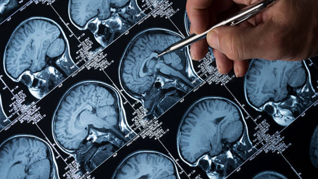 Brain aging: Expert explains causes and how to reduce impact of degeneration – Times of India