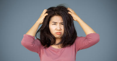 Does applying hair oil increase dandruff?