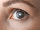 Cataract: Causes and prevention tips to follow